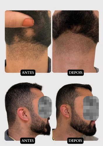 Resultado capilar 10