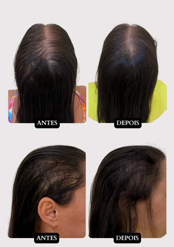 Resultado capilar 12