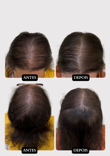 Resultado capilar 13