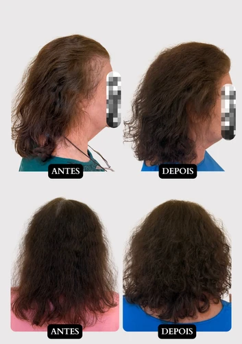 Resultado capilar 14