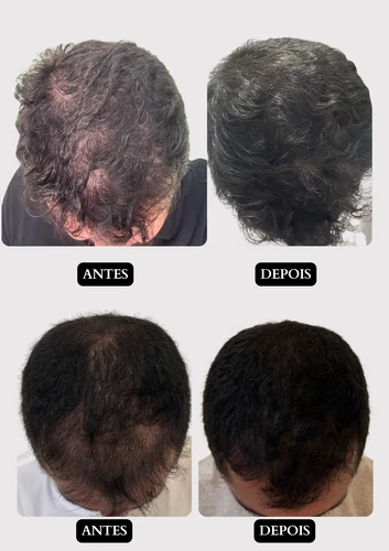 Resultado capilar 15