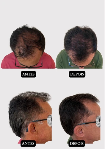 Resultado capilar 16