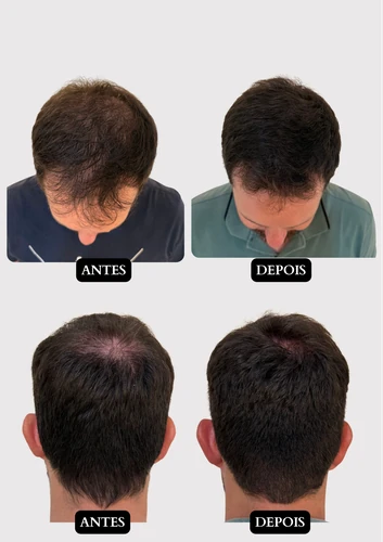 Resultado capilar 18