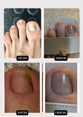 Resultado doença de pele 10