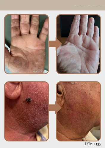 Resultado doença de pele 3