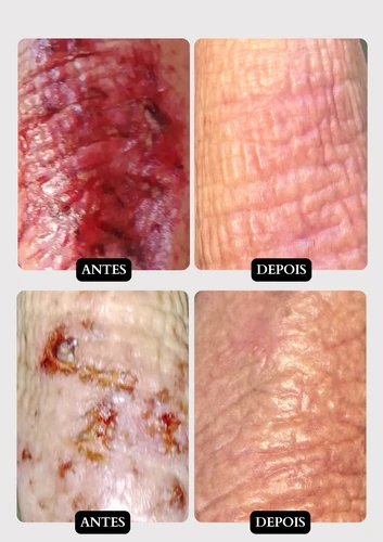 Resultado doença de pele 5