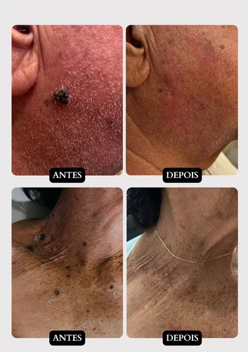 Resultado doença de pele 6