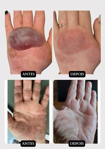 Resultado doença de pele 7