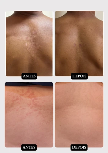 Resultado doença de pele 8